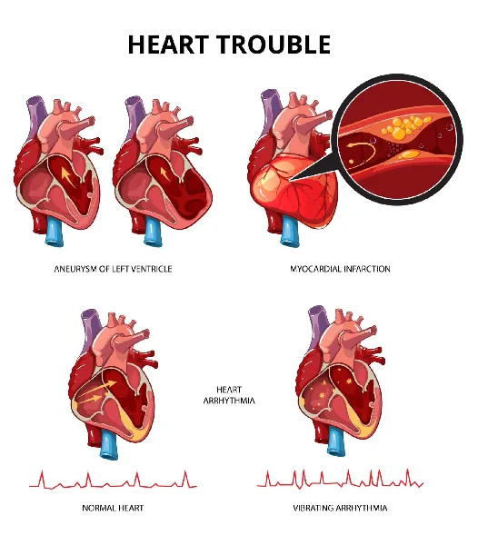 Breaking Down Cardiovascular Disease
