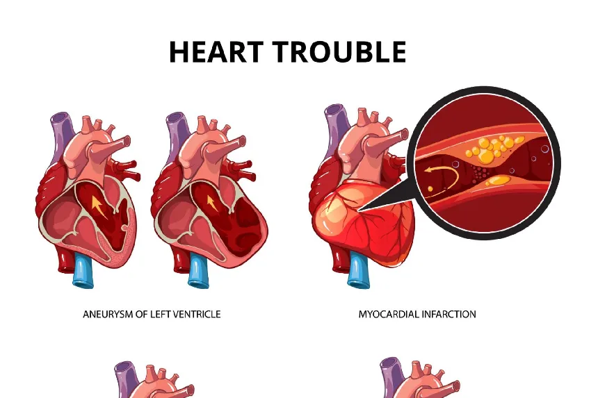 Breaking Down Cardiovascular Disease