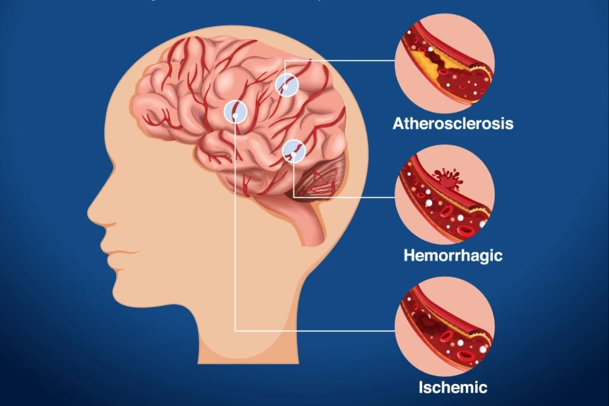 Discover stroke prevention insights from the best neurologist doctor in Abu Dhabi.